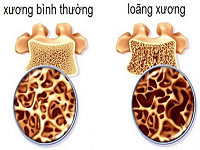 NHỮNG ĐIỀU CẦN BIẾT VỀ THOÁI HÓA XƯƠNG KHỚP