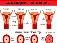 NHỮNG LOẠI UNG THƯ GẶP Ở NỮ VÀ CHI PHÍ SÀNG LỌC THẤP