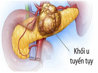 NHỮNG DẤU HIỆU NHẬN BIẾT UNG THƯ TUYẾN TỤY GIAI ĐOẠN SỚM