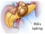 NHỮNG DẤU HIỆU NHẬN BIẾT UNG THƯ TUYẾN TỤY GIAI ĐOẠN SỚM