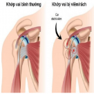 BẤM HUYỆT TRỊ LIỆU VIÊM GÂN CƠ NHỊ ĐẦU VAI