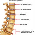 BẤM HUYỆT TRỊ LIỆU THOÁI HÓA CỘT SỐNG THẮT LƯNG