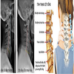 BẤM HUYỆT TRỊ LIỆU THOÁI HÓA ĐỐT SỐNG CỔ