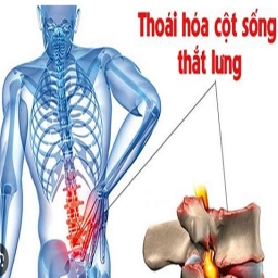 BẤM HUYỆT TRỊ LIỆU THOÁI HÓA CỘT SỐNG THẮT LƯNG