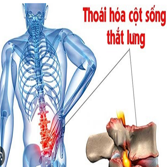 BẤM HUYỆT TRỊ LIỆU THOÁI HÓA CỘT SỐNG THẮT LƯNG