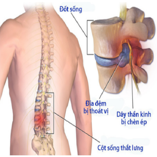 BẤM HUYỆT TRỊ LIỆU ĐAU DÂY THẦN KINH LIÊN SƯỜN